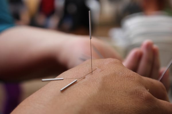 Combien de séances d'acupuncture pour un résultat optimal à Valence ?